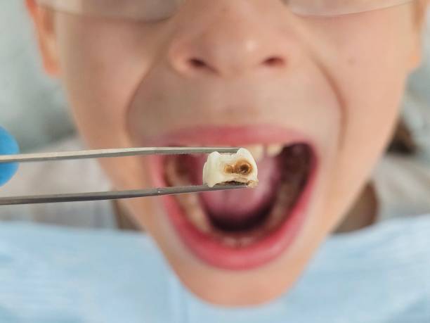 Best Emergency Dentist for Lost Fillings or Crowns in Slater Marietta, SC